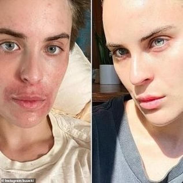 The 30-year-old daughter of Bruce Willis and Demi Moore took to Instagram to share incredible before-and-after photos of her face 'healing' from the condition