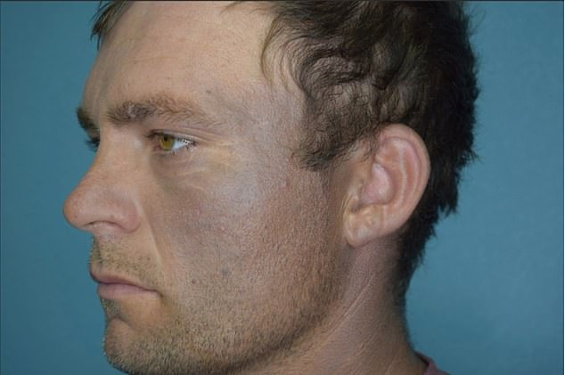 This image also shows the patient with blue skin on the side of his face, which did not disappear