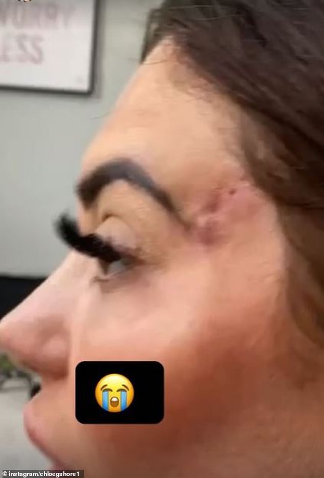The TV personality was left with a major identity after a poorly executed 'fox eye facelift' in 2022, but is now proudly showing off the results of a treatment to fade the blemish