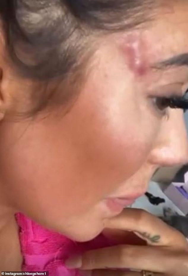 Two years ago, Chloe opened up about the huge impact her botched 'fox eye' lift had on her life, revealing she had 'been through hell' since the procedure.