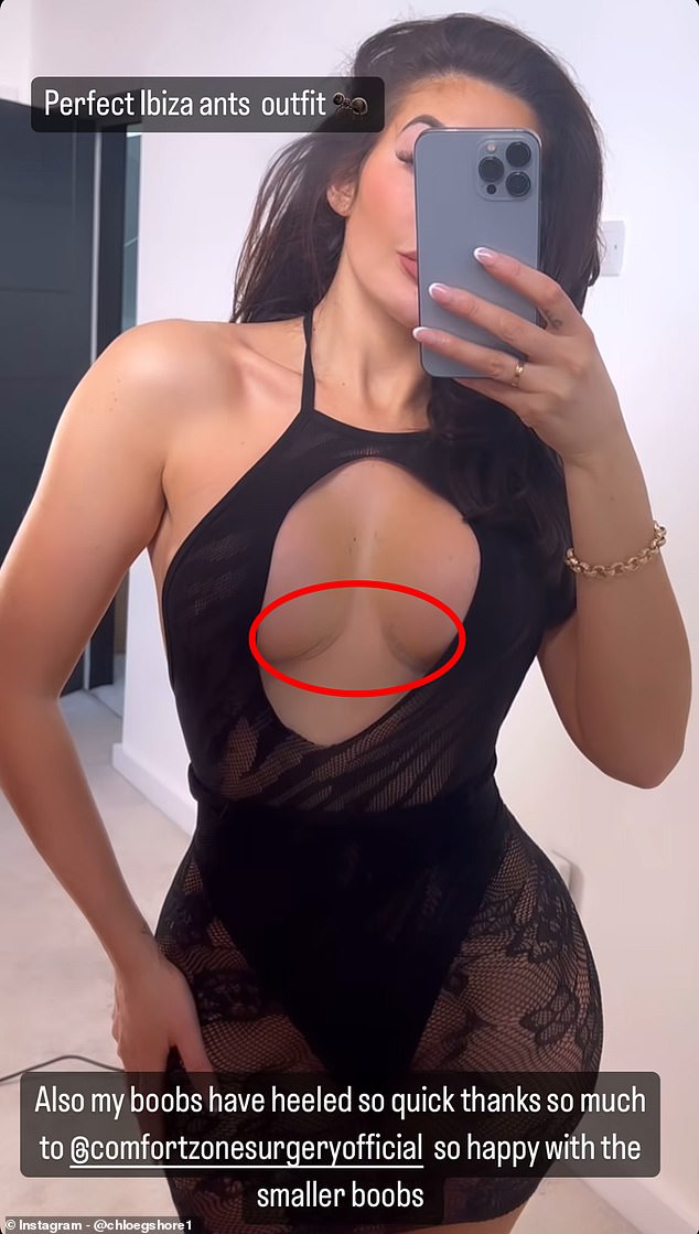 The reality star proudly showed off her corrective boob job scars on Instagram in a daring dress with a cut-out section