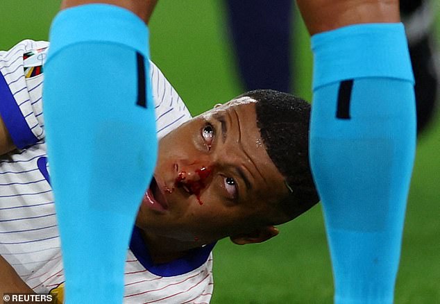 Mbappé bled profusely from the nose immediately after sustaining the injury