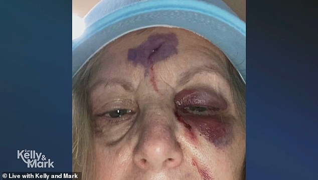 Howie shared a photo of Terry's injuries, which included cuts on her forehead and cheek, a black eye and a huge purple bruise