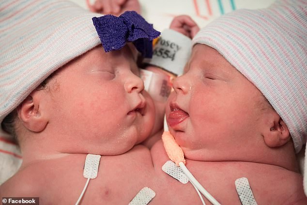 The doctors were so sure they wouldn't make it past the first day that the couple didn't buy any clothes for them, leaving them unprepared when the girls defied the odds and survived.