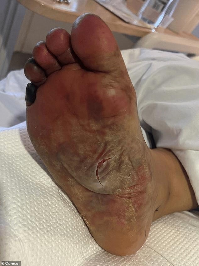 When the patient's circulation was cut off, her toe began to turn black.  Doctors think it may need to be amputated