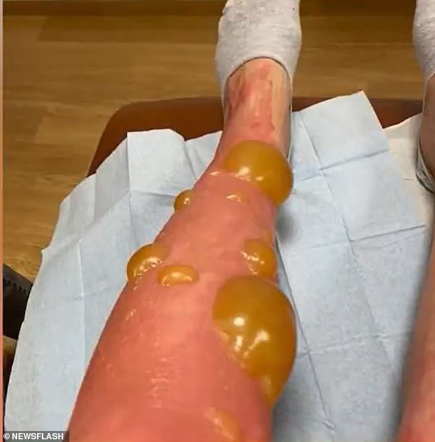 The next morning, however, mother and daughter woke up to find red and yellow blisters covering their arms and legs.  Details about the actual disease are scarce
