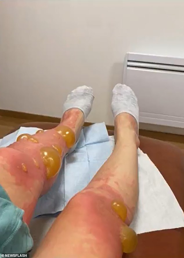 But medics believe they may have suffered from phytophotodermatitis – a painful reaction that occurs when plant chemicals applied to the skin are exposed to sunlight
