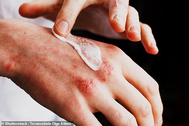 Eczema is a skin condition that causes irritated, dry, red patches to appear all over the skin.  It can develop in response to an allergy or it can be a chronic condition.