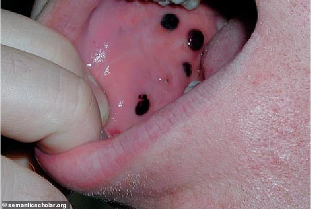 Idiopathic thrombocytopenic purpura (ITP) - is a rare autoimmune disease that affects the number of platelets in the blood, and one of the symptoms may be black spots in the mouth