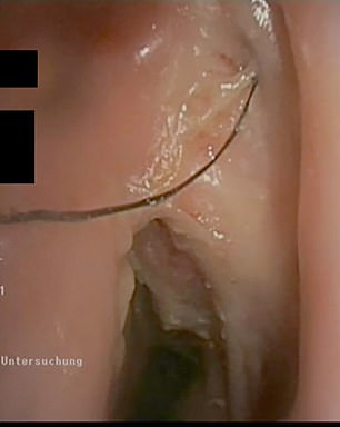The image above shows hairs growing in the throat