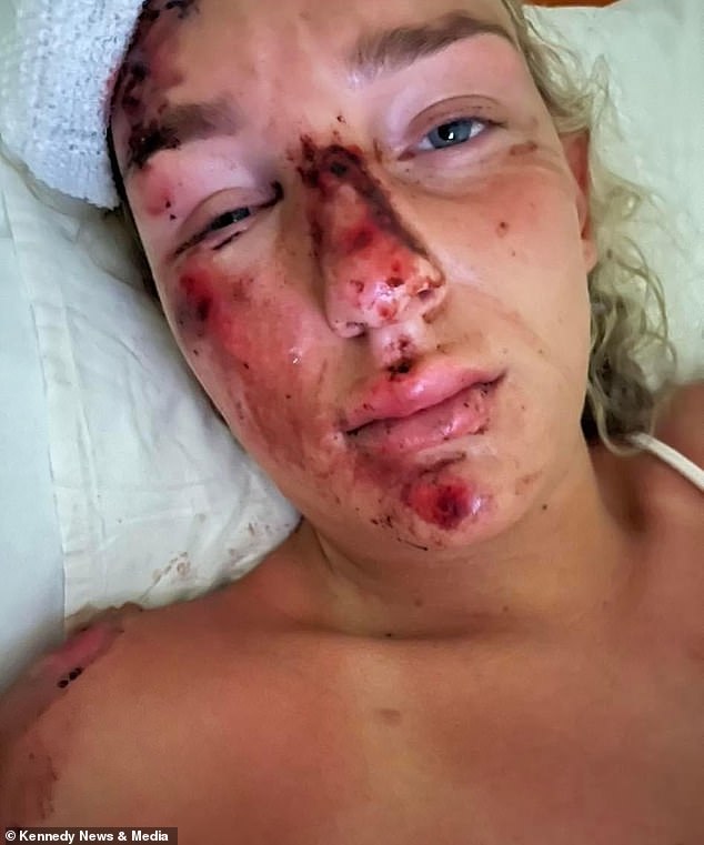 Following the horror smash, Holly was left with serious cuts and bruises to her face, which her mother claims will leave her 'permanently scarred'.