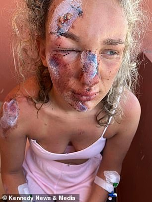 Holly claims a speeding car hit her quad bike at 50mph, sending her flying into the air and landing on her face