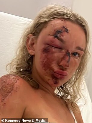 Holly claims a speeding car hit her quad bike at 50mph, sending her flying into the air and landing on her face