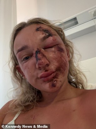 Doctors have told Holly that her injuries could take months to heal