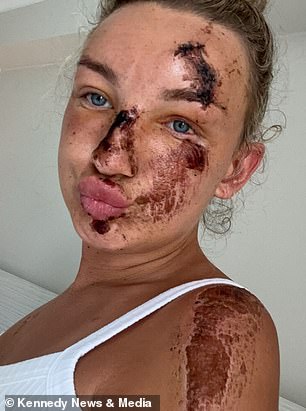 Doctors have told Holly that her injuries could take months to heal