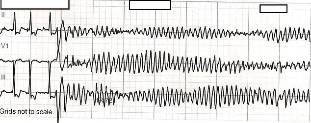 The woman's heart rate was disorganized and at times very low and at other times very high.  The photo above is an example of an irregular heat stroke