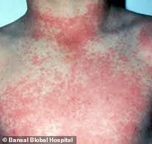 One of the symptoms of dengue fever is a skin rash, as shown above