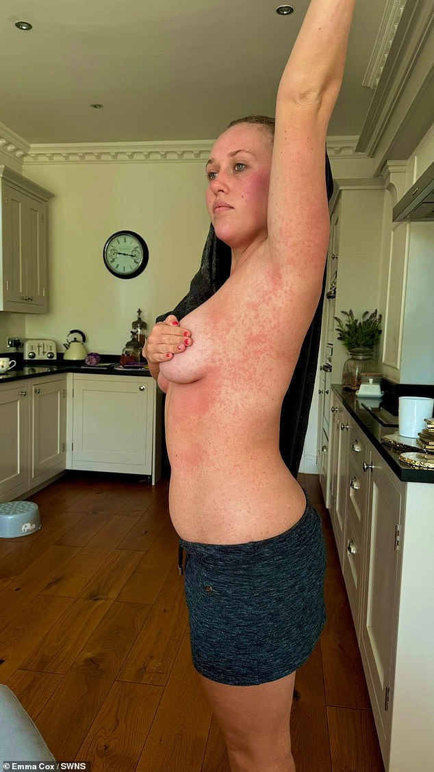 Emma Cox, 27, is among those suffering from dengue fever.  She had traveled to Indonesia but developed symptoms ten days after returning to Britain