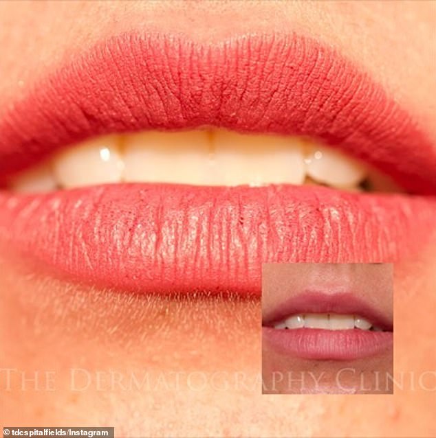 A photo of a woman's lips after permanent full-lip contouring at a dermatology clinic in London