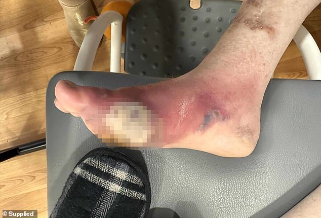 Mr Trigg took antibiotics just weeks after going off the gum as the infection seemed to spread and started to smell (seen: his right foot before being taken to hospital)