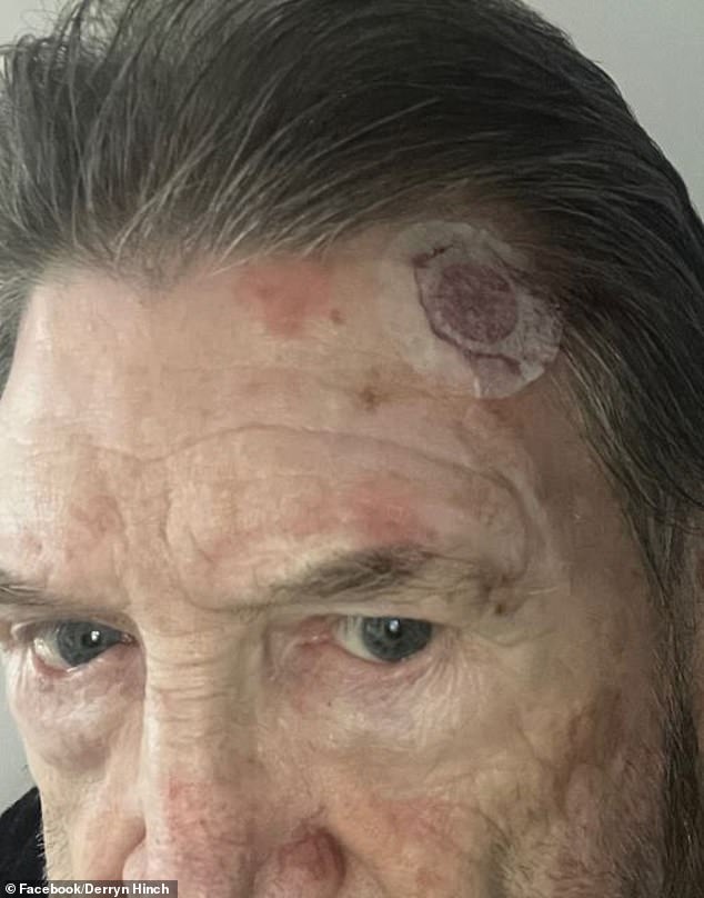 The Australian media personality, 80, said he is currently undergoing five weeks of daily radiation in a bid to get rid of a melanoma on his forehead.