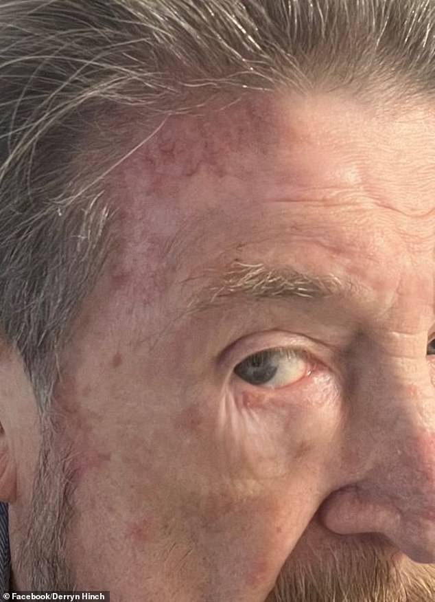 The cancerous spot just below his hairline was first discovered by doctors in February and he underwent two surgeries to remove it, and is now undergoing radiation as 'insurance'