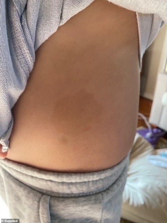 Tom's pediatrician noticed that he had cafe au lait spots on his body. Cafe au lait spots are pigmented birthmarks that are harmless in most cases, but are a common sign of NF1