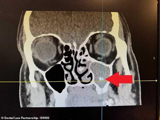 A CT scan revealed that he had a sinus infection on the left side, caused by a piece of tooth that had been pushed into his sinus