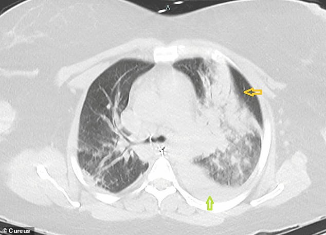 The patient's CT scans showed fluid filling the left side of her lungs.  She soon developed respiratory and renal failure