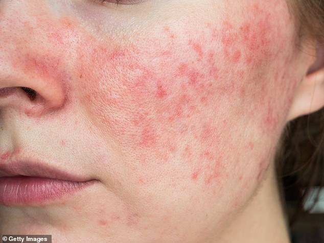 Rosacea is an inflammatory condition that causes flushing and redness in the face, pimples and irritation around the eyes