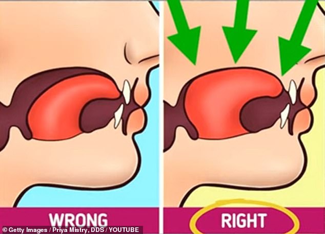 For proper tongue position, lightly press the entire tongue against the roof of the mouth with gentle suction.  Improper posture includes a slight prolapse of the tongue.