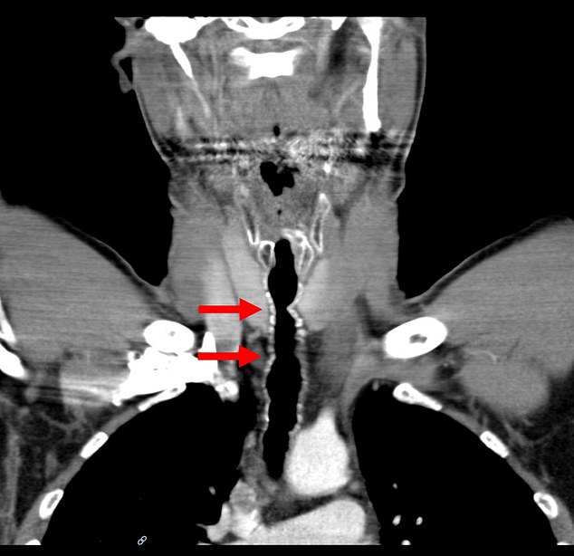 Above is a scan of the individual's throat, with the arrows pointing to places where the trachea (or windpipe) has become narrowed