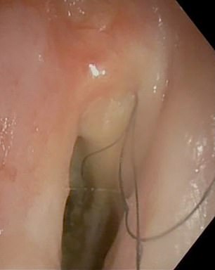 The above image shows three hairs growing in the throat, below the larynx