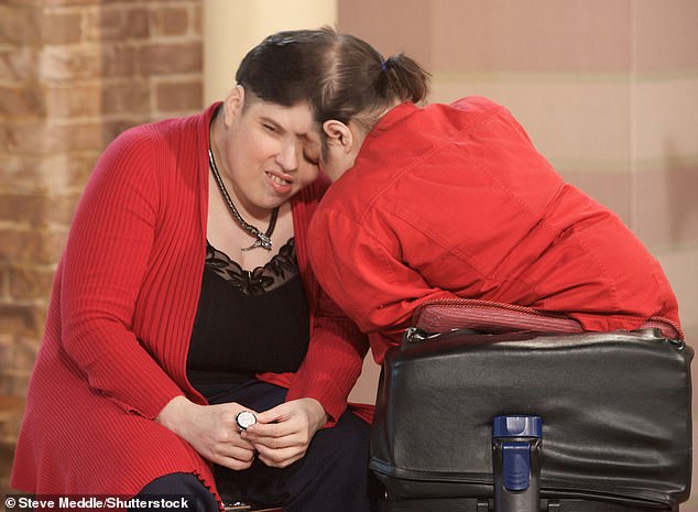 Lori and her transgender twin brother George were born with their skulls and the left side of their foreheads fused in Reading, Pennsylvania in 1961 (photo, in September 2011)