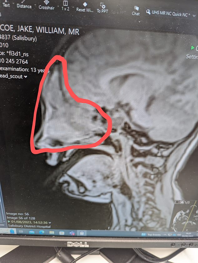 A CT scan revealed a growth in Jake's skull the size of an egg that was pressing on his brain, causing the hay fever-like symptoms.