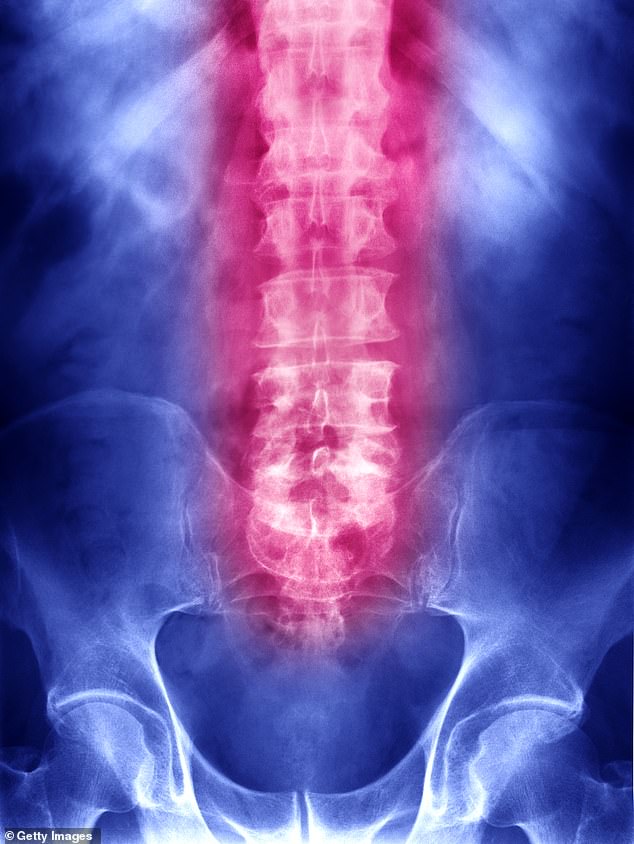 Fracture Liaison Services (FLS) identifies people over 50 years of age who arrive at the Emergency Department with broken bones and screens them for fragility fractures (Stock Image)