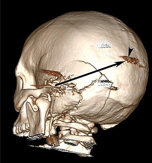 This scan shows the path of the bullet in the head