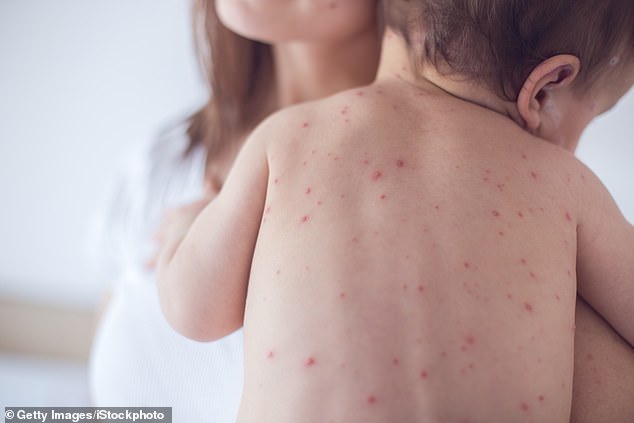 More than 90 percent of the population is immune to chickenpox, but newborns can develop complications from it