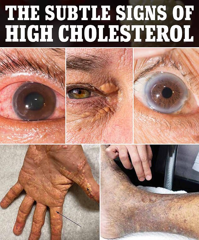 Yellowish bumps on the hands, yellow due to the color of fat deposits, are a characteristic signal that a person has high cholesterol.  Yellow bumps around the eyes are not usually painful, but may indicate that fats are building up in your bloodstream