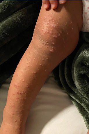 Bumps on the leg indicative of foot-and-mouth disease in the one-year-old patient