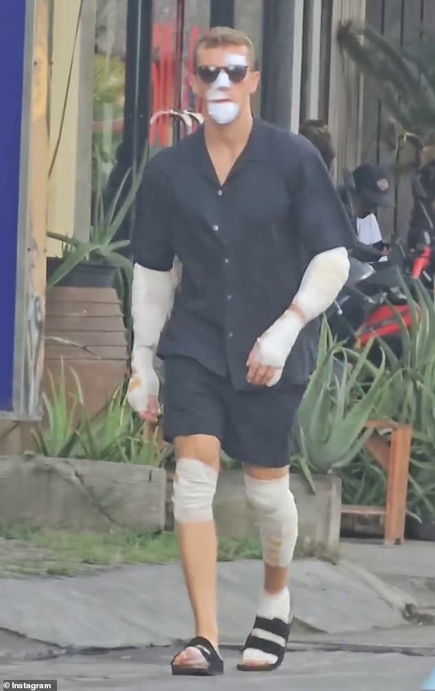 James Marsland was photographed in Canggu with several bandages