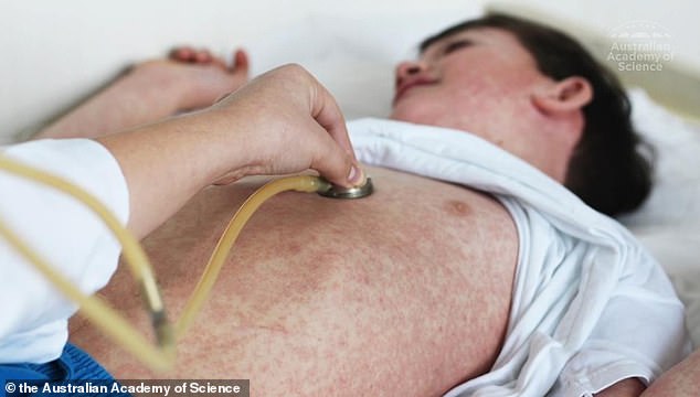 Measles is a highly contagious disease caused by a virus that infects the respiratory tract, later spreading throughout the body (stock image)