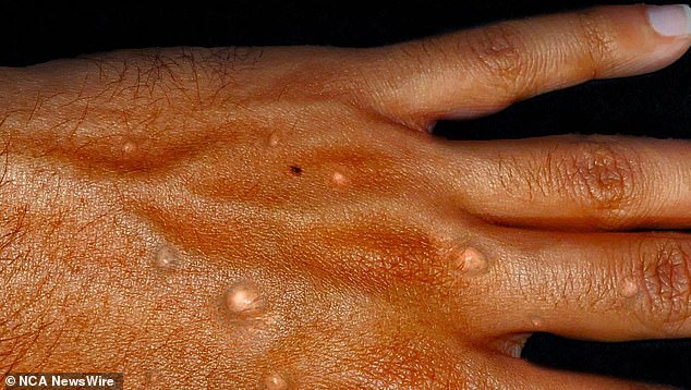 Mpox is spread through contact with bodily fluids.