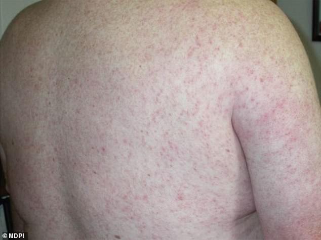 About one in five patients develop symptoms of West Nile disease, including a rash, as pictured above.  Less than one percent of them suffer from a severe form of the disease