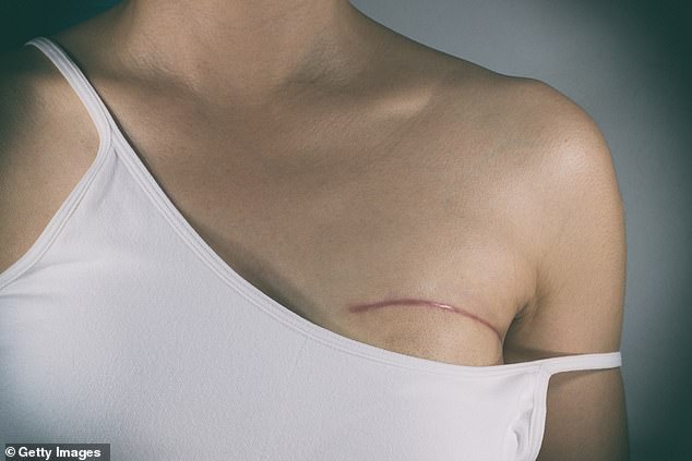 A mastectomy is often seen as the surest way to prevent breast cancer from returning and around 15,000 women in Britain undergo the operation every year