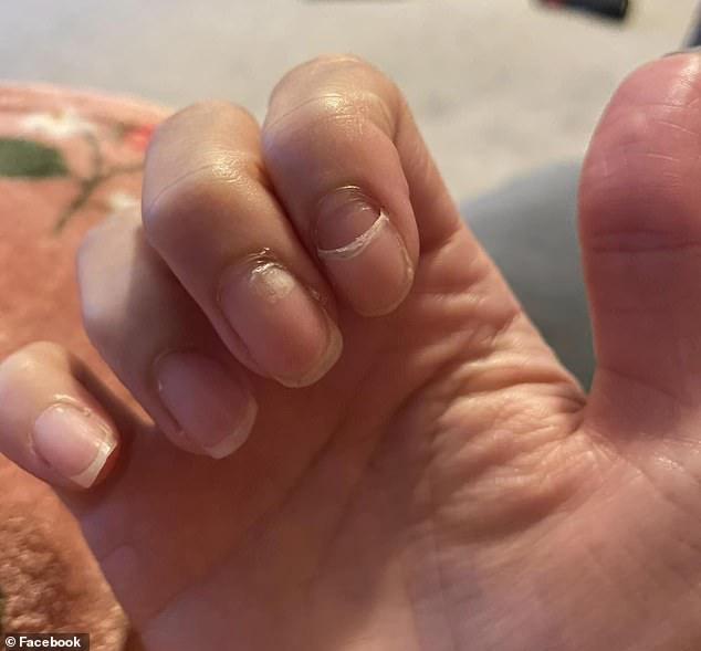 A young mother whose nails started shedding like a snake's skin one morning has finally discovered why