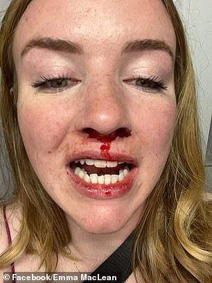 Emma MacLean said she was left with a chipped tooth, a broken nose and bruises after the crash
