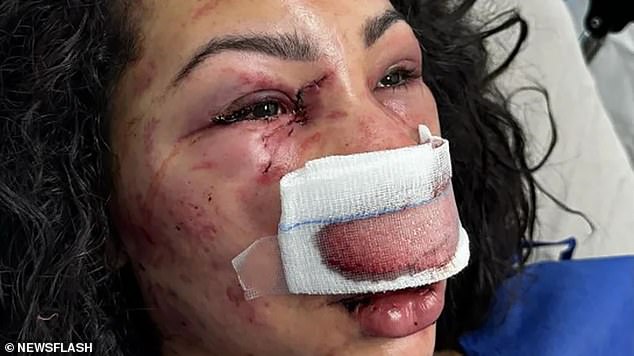 Former bodybuilder Nunes was rushed to hospital in critical condition after suffering broken eye sockets, jaw and nose, as well as numerous bruises. She will now require reconstructive facial surgery