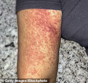 About one in four people infected experience symptoms of the virus, including a rash