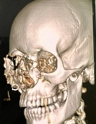 An X-ray of Becci Ode's head after the catastrophic accident in Bali a week ago